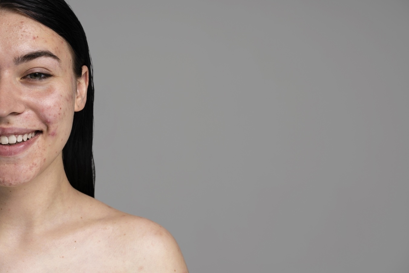 Trądzik młodzieńczy – przyczyny, objawy, leczenie i pielęgnacja skóry
